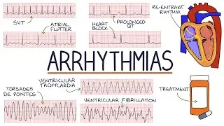 Understanding Arrhythmias