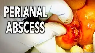 LANCING & DRAINING A PERIANAL ABSCESS! (Blood & Pus Warning) | Dr. Paul