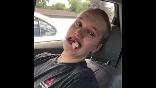 After Andy’s Wisdom Teeth Removal