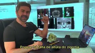 Zygoma or Transnasal Implants?