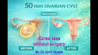 50mm Ovarian Cyst cured without surgery |permanent cure of ovarian cyst ||Homoeopathic wonder cure||