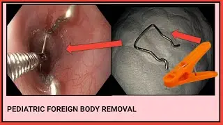 Pediatric Foreign Body Removal Of Clothe Clip Lock Metallic Hook l ফরেন বডি রিমুভাল #BD_ENDOSCOPY