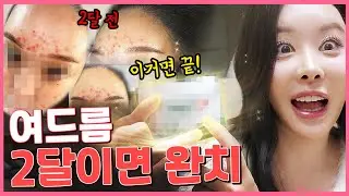 아직도 이소티논 드시나요? 이렇게만 하세요! '탱다의 최신 피부관리법'