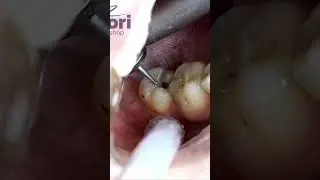 Caries preparation - what is done before filling