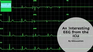 An Interesting EEG in the ICU