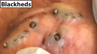 Best Deep Big Removal Of Blackheads On Ear