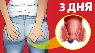 3 СТАДИЯ ГЕМОРРОЯ.3 ДАРАЧАИ ГЕМОРРОЙ.