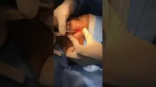 Dermabresion for pimples removal