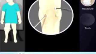 ACL Reconstruction With a Bone Patellar Bone Graft