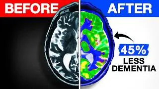 BREAKING! Reduce Your Dementia Risk By 45%