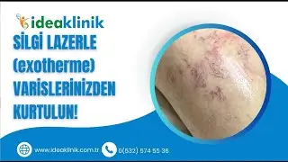 Silgi Lazer (Exotherme) İle Varislerinizden Kurtulun!