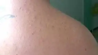PLE shoulder after treatment