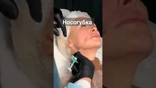 Коррекция носогубной складки филлерами с помощью атравматической канюли.