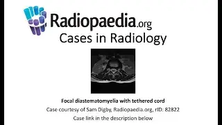 Focal diastematomyelia with tethered cord (Radiopaedia.org) Cases in Radiology