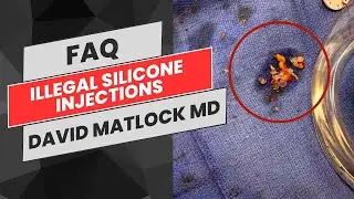 ILLEGAL INJECTION REMOVAL | FREQUENTLY ASKED QUESTIONS | DAVID MATLOCK MD