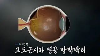 [명의 의학백과📖] 고도근시와 열공 망막박리