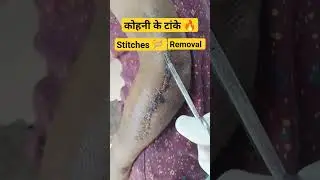 Elbow Stitches Removal ☑️ 