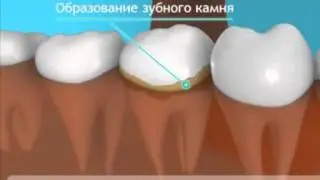 Periodontitis. How to treat periodontitis
