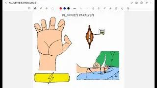 KLUMPKE'S PARALYSIS
