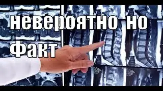 Грыжи Исчезли от этих упражнений