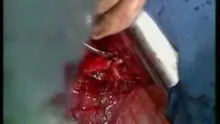 plaushu_operacija.flv