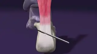 Haglunds Procedure with the BioPro Tendon Anchor System
