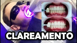 TUDO SOBRE CLAREAMENTO DENTAL A LASER
