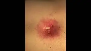 НОВОЕ ВИДЕО 2022  Прыщи давить залипательные