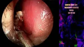 RHINOLITH REMOVAL