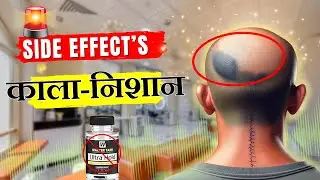 Side effects of Hair Patch & Wigs | हेयर पैच के नुकसान