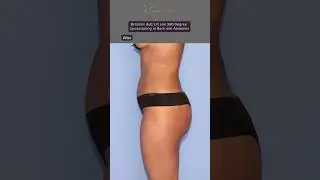 BBL & 360 Liposculpting of Back and Abdomen 🍑