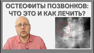 Остеофиты позвонков: самое главное