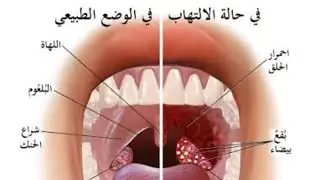 التهاب اللوزتين  عند الاطفال ..اسبابه .. اعراضه .. علاجه .. متى يجب استئصالهم ؟