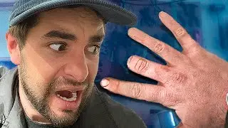 Finger chopped off (camera gear accident)