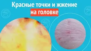 😮 Красные точки и жжение на головке. Клинический случай №1227