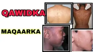 XANUUNKA QAWIDKA(Tinea vesicolor)|SABABAHA IYO DAAWADA💊|xogocafimad