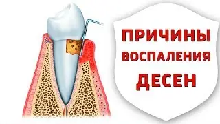 Пародонтит, гингивит, пародонтоз - причины, профилактика и лечение заболеваний десен | Дентал ТВ