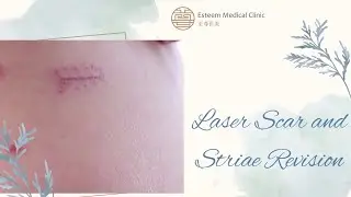 Laser Scar and Striae Revision | Fotona | Esteem Medical Clinic | Dubai