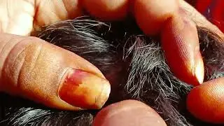 full big lices by nitipicking/in telugu