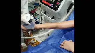 Advanced high speed laser hair removal using the German-made Mediostar machine