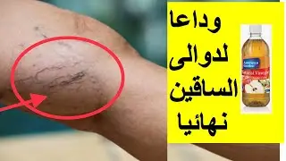 علاج  دوالي الساقين  (الاوردة العنكبوتية) بخل التفاح  نهائيا