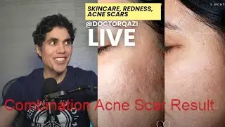 Dr. Qazi discusses Skincare, Redness, Benzoyl Peroxide | Dr. Qazi Unsponsored Live | 3.10.2025
