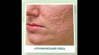 МЦ РИВЕР: Коррекция рубцов