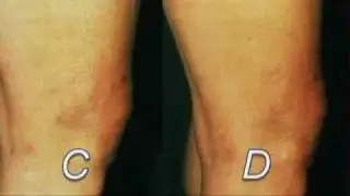 Varicose Veins (Part 4) Signs Symptoms Diagnosis Treatment