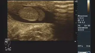 Физиологическая водянка оболочек яичек