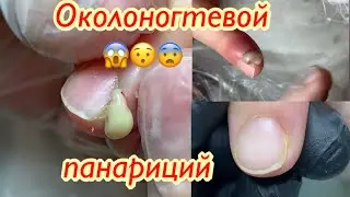 Околоногтевой панариций💅🏻
