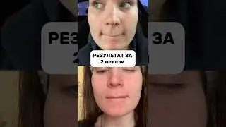 Cleansed pores in 2 weeks. The results are obvious! 