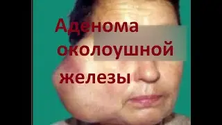 Аденома околоушной железы