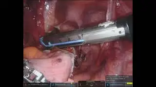Robotic Frykman-Goldberg procedure for complete rectal prolapse – A video vignette