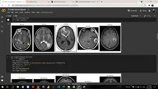Brain Tumor Classsification in deep learning
